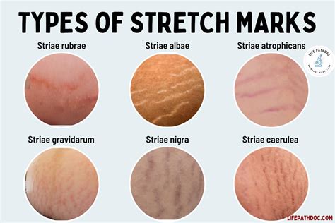 Why Stretch Marks Itch: The Curious Connection Between Skin and Sensation